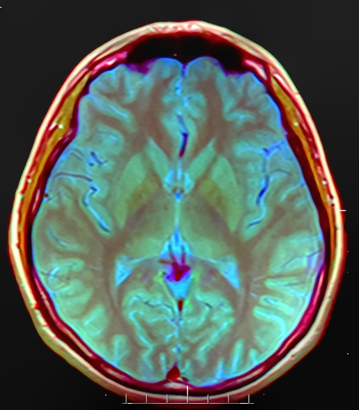 MRI scan of a brain. photo by Wikimedia Commons